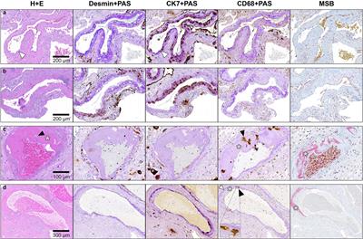 Acute Atherosis Lesions at the Fetal-Maternal Border: Current Knowledge and Implications for Maternal Cardiovascular Health